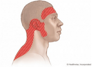 headache causes - tension-type