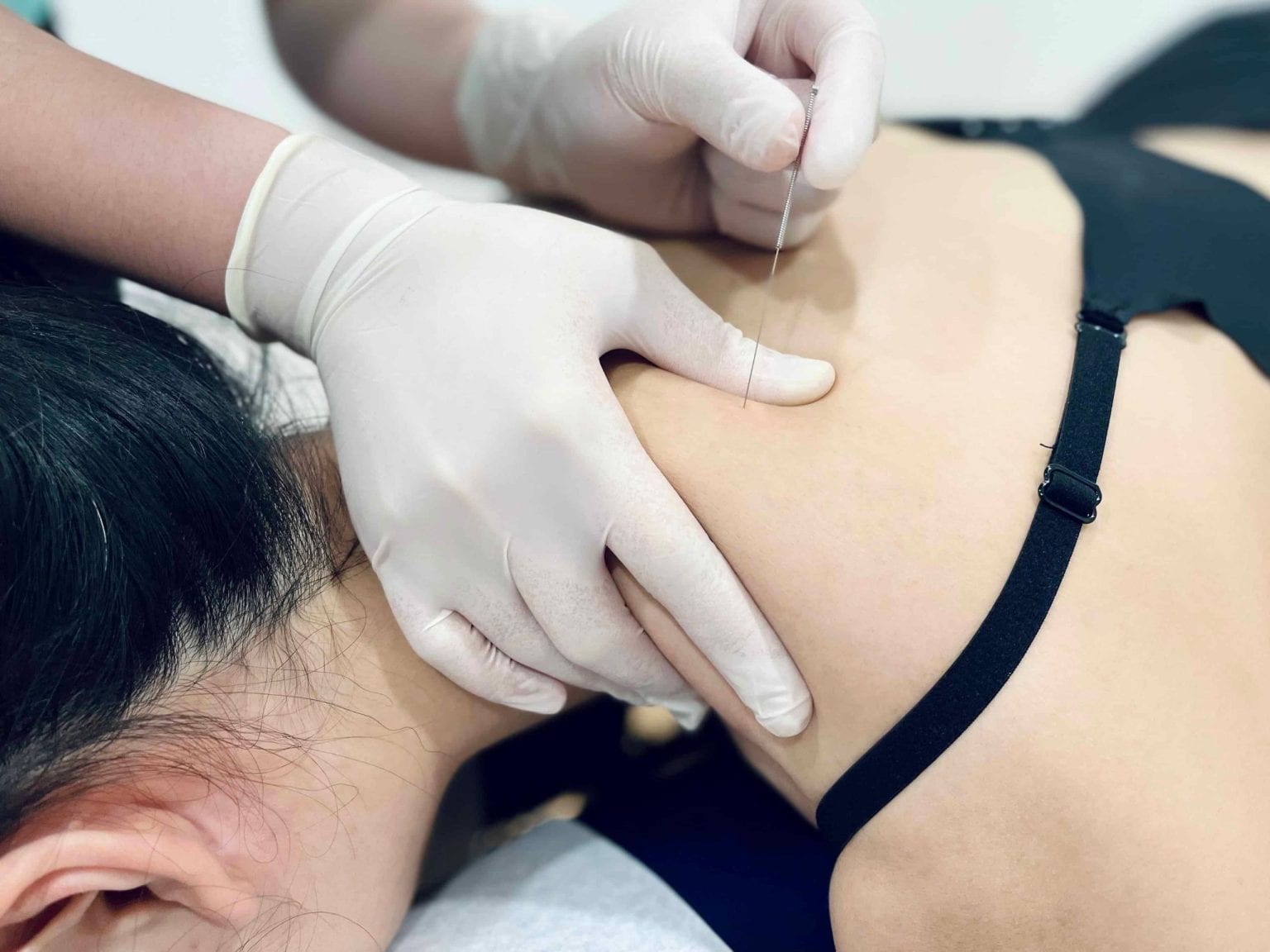 Dry needling being performed on a patient